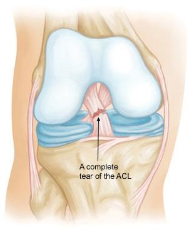 Torn ACL