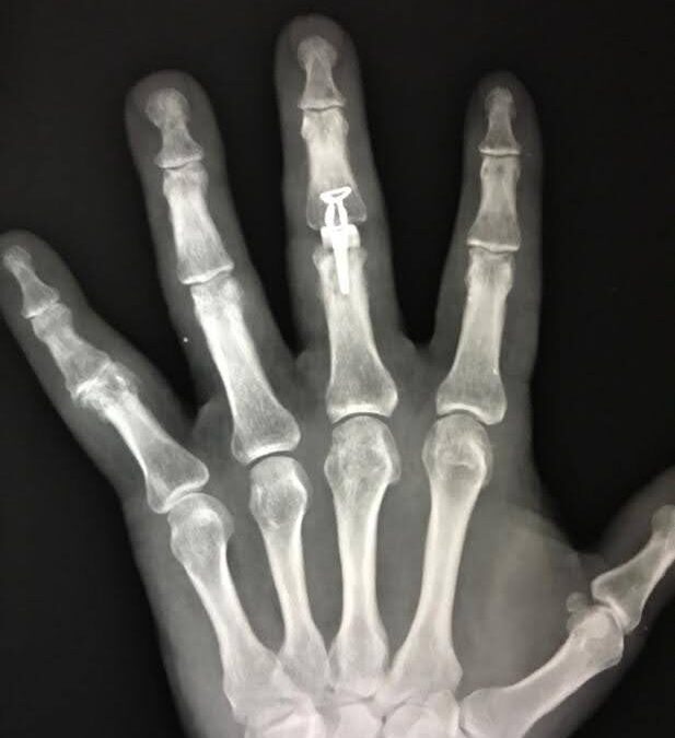 Finger Joint Arthritis and Joint Replacement Arthroplasty