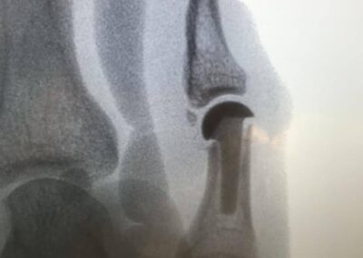 Joint Replacement Arthroplasty - Case 4