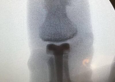 Joint Replacement Arthroplasty - Case 4